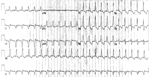 Read more about the article ECG Case 39