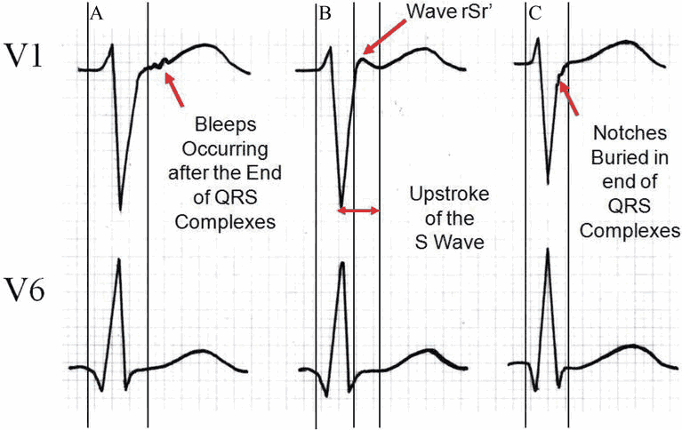 Epsilon Waves in Arrhythmogenic right ventricular dysplasia (ARVD)