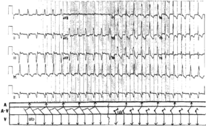 Read more about the article Inferior MI and AVNRT or Accelerated Junctional Rhythm