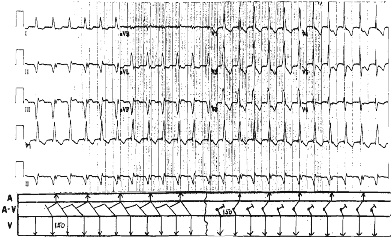 Inferior MI and AVNRT or Accelerated Junctional Rhythm