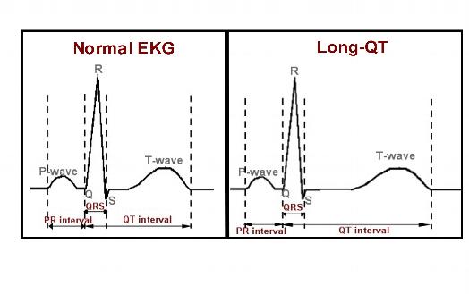 Long QT Syndrome