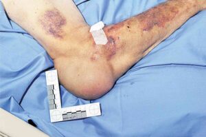 Read more about the article Patient with Bilateral Tender Fluctuant Masses Over Each Elbow
