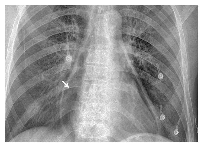 Pneumopericardium from perforated esophageal ulcer
