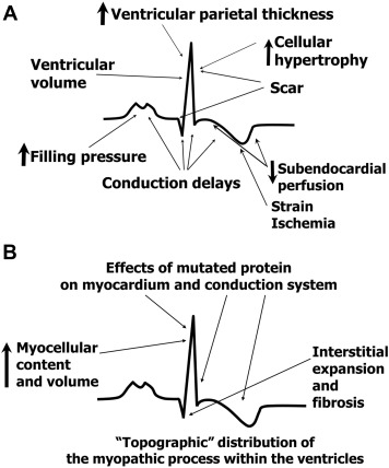The ECG in Hypertrophic cardiomyopathy (HCM)