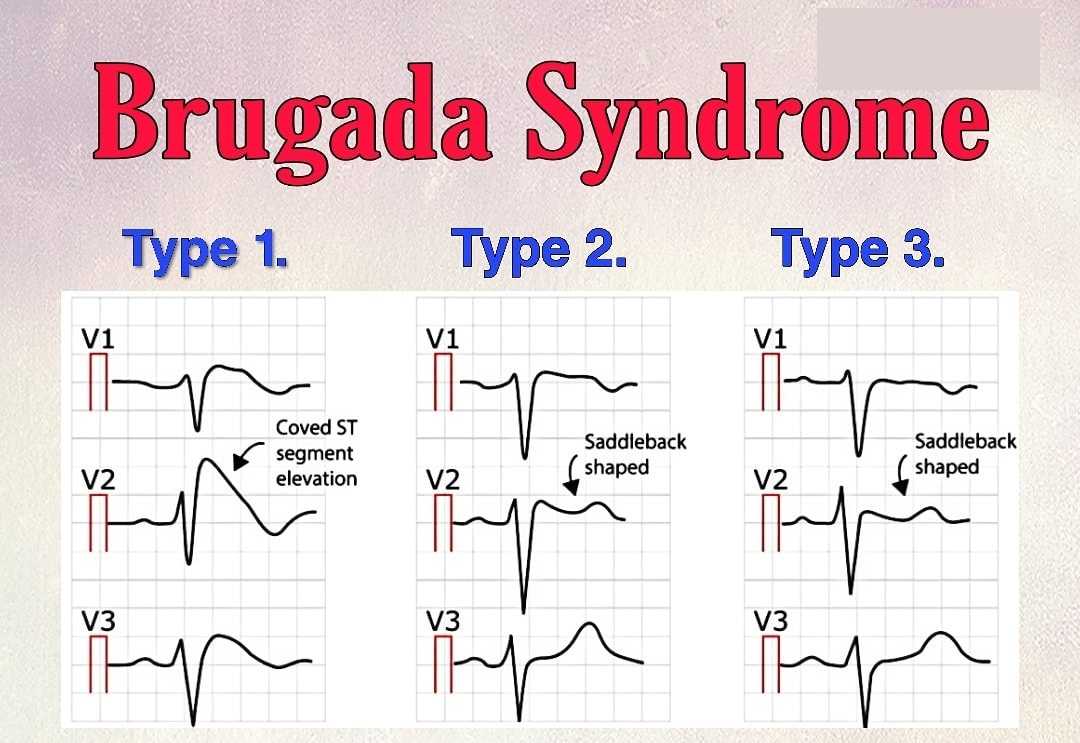 Types of Brugada Syndrome