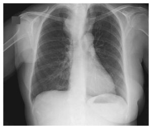 Read more about the article 67-year-old Woman with a 6-month History of Dyspnea and Dysphagia