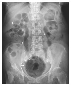 Read more about the article Acute Emphysematous Cystitis with Air in the Urinary Tract