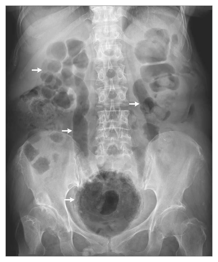 Acute Emphysematous Cystitis with Air in the Urinary Tract
