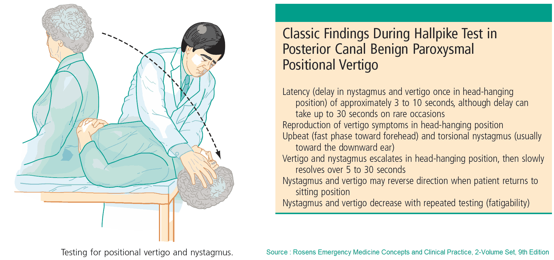 Classic Findings During Hallpike Test in Posterior Canal Benign Paroxysmal Positional Vertigo (BPPV)