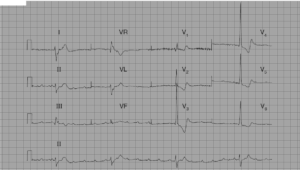 Read more about the article Complete (third degree) Heart Block in 80-year-old woman