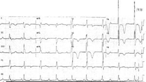 Read more about the article ECG Case 43