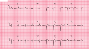 Read more about the article Anterior MI with Terminal (reperfusion) T Wave Inversion