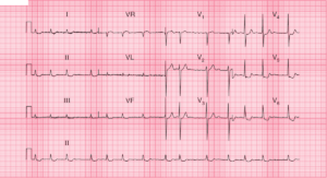 Read more about the article Atrial Fibrillation with Digoxin Effect