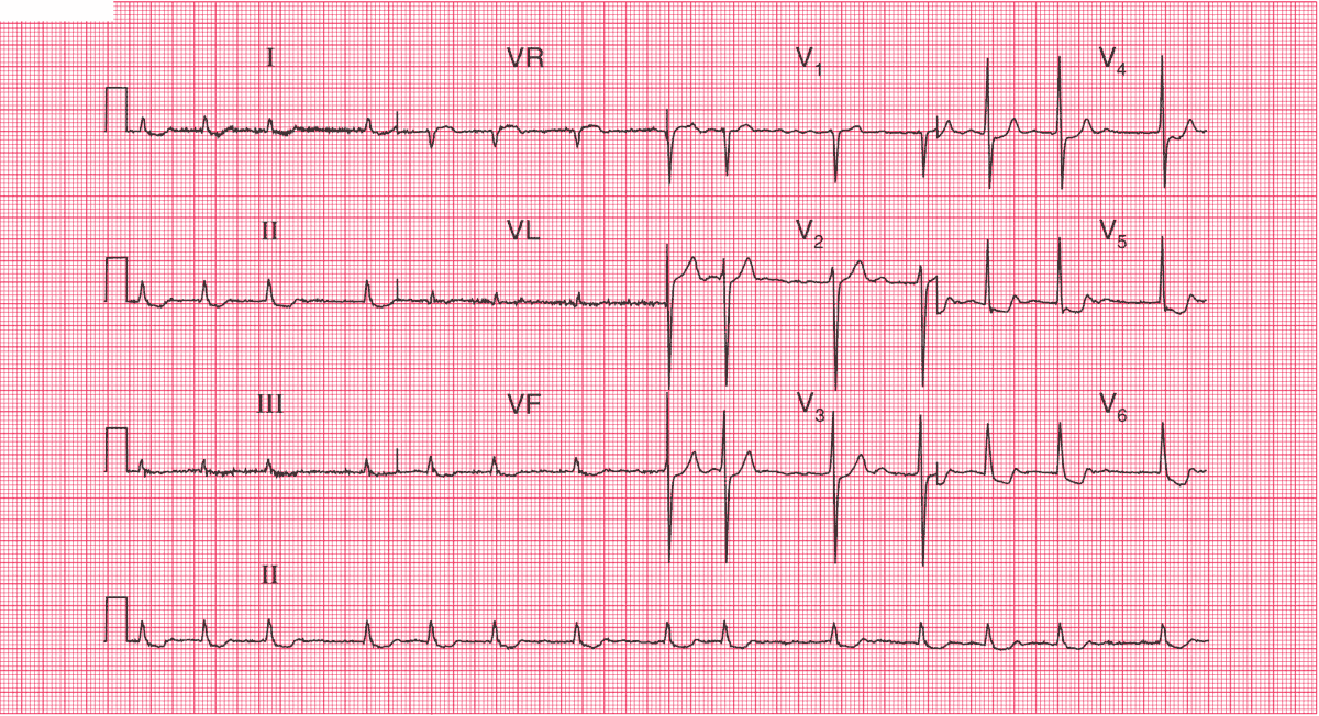 Read more about the article ECG Case 45