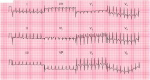 Read more about the article Atrioventricular nodal re-entry tachycardia (AVNRT)