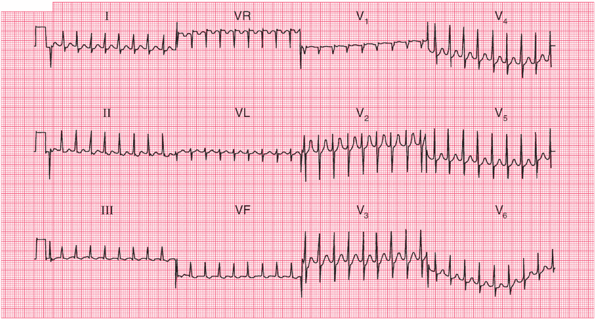 Read more about the article ECG Case 46