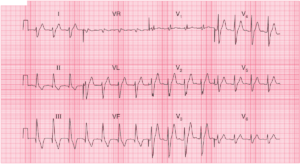Read more about the article RBBB and Left Posterior Fascicular Block (LPFB)