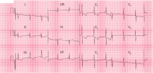 Read more about the article Severe Right Ventricular Hypertrophy (RVH)