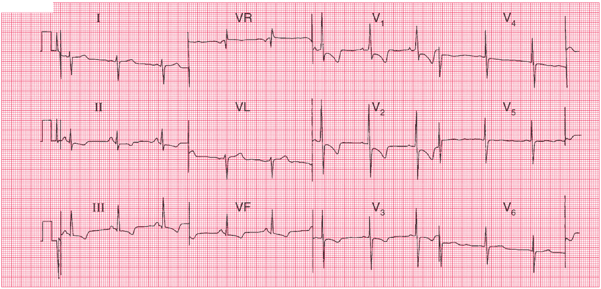 Read more about the article ECG Case 48