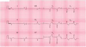 Read more about the article Atrial Fibrillation and LBBB