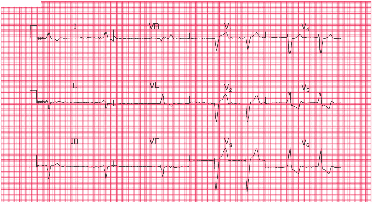 Atrial Fibrillation and LBBB