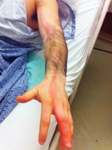 Read more about the article Erythematous and Irregular Linear Streak Extending from the Hand to the Axilla