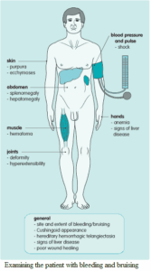 Evaluation of the Patient with Bleeding and Bruising - Manual of Medicine