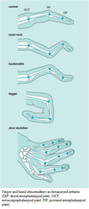 Evaluation of the Patient With Joint Disease - Manual of Medicine