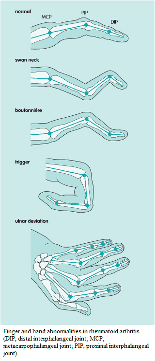 Finger and hand abnormalities in rheumatoid arthritis