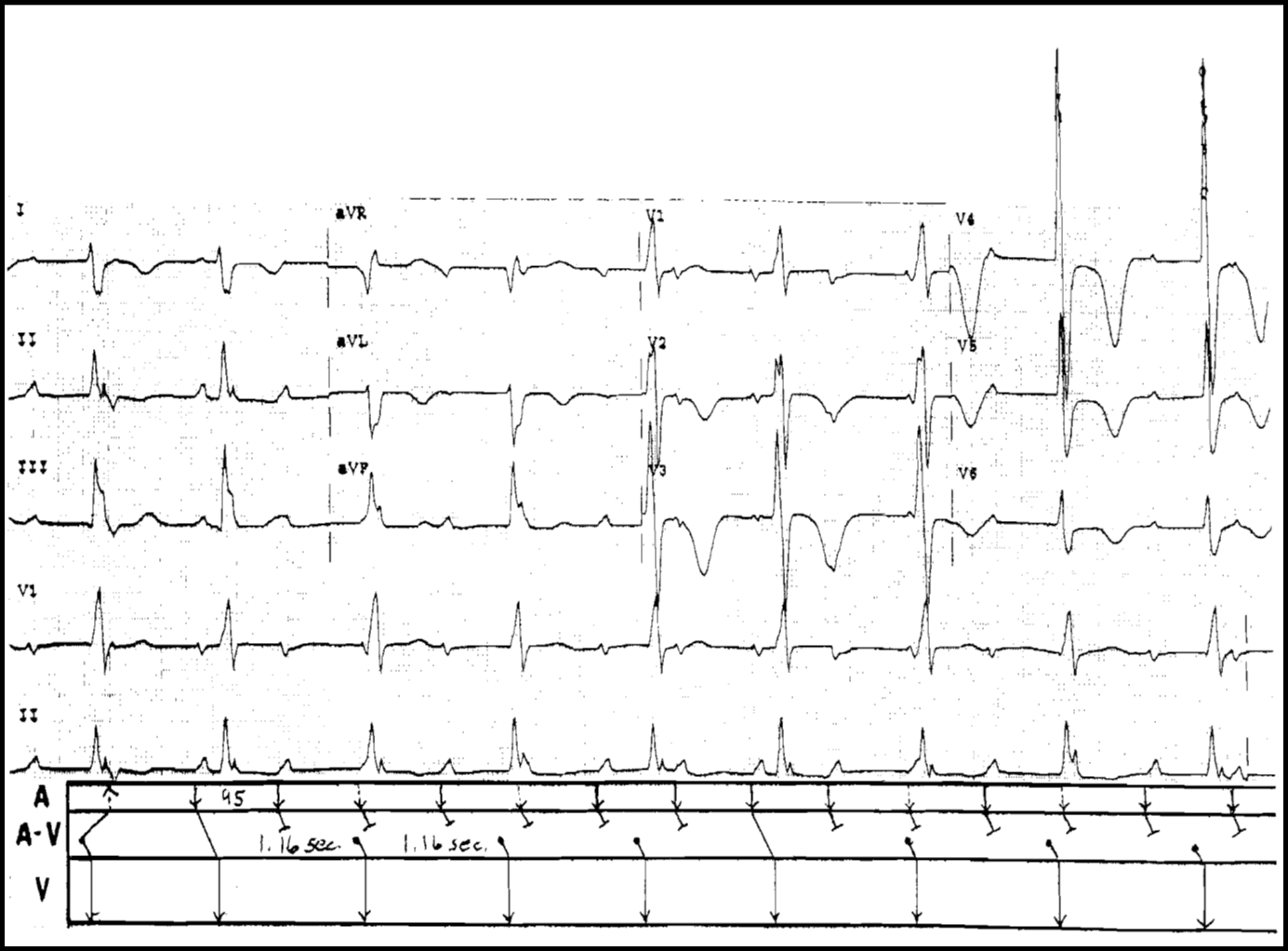 High Grade Av Block Management