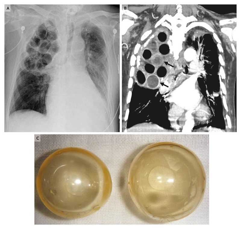 MRSA Pneumonia 57 Years after Extrapleural Pneumonolysis (Plombage)