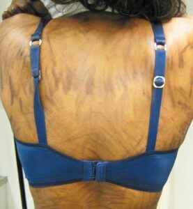 Read more about the article Painless, Nonpruritic, Flagellate Hyperpigmentation on Trunk
