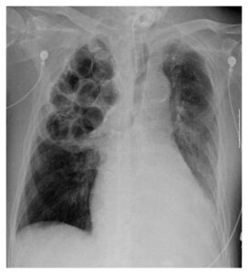 Read more about the article Patient with Repeated Episodes of Septic Shock and History of Pulmonary Tuberculosis in the Past