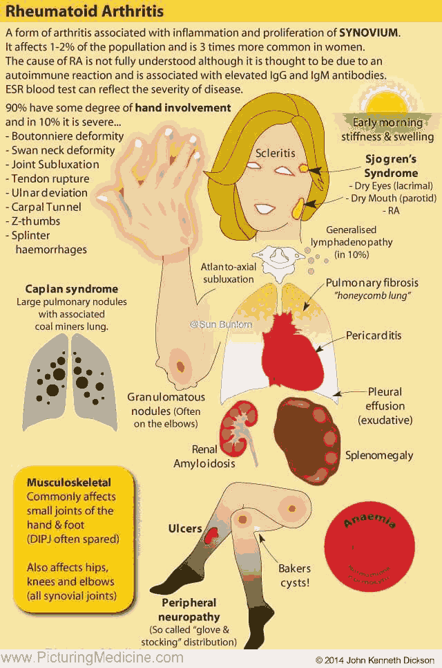 Rheumatoid Arthritis - Summary