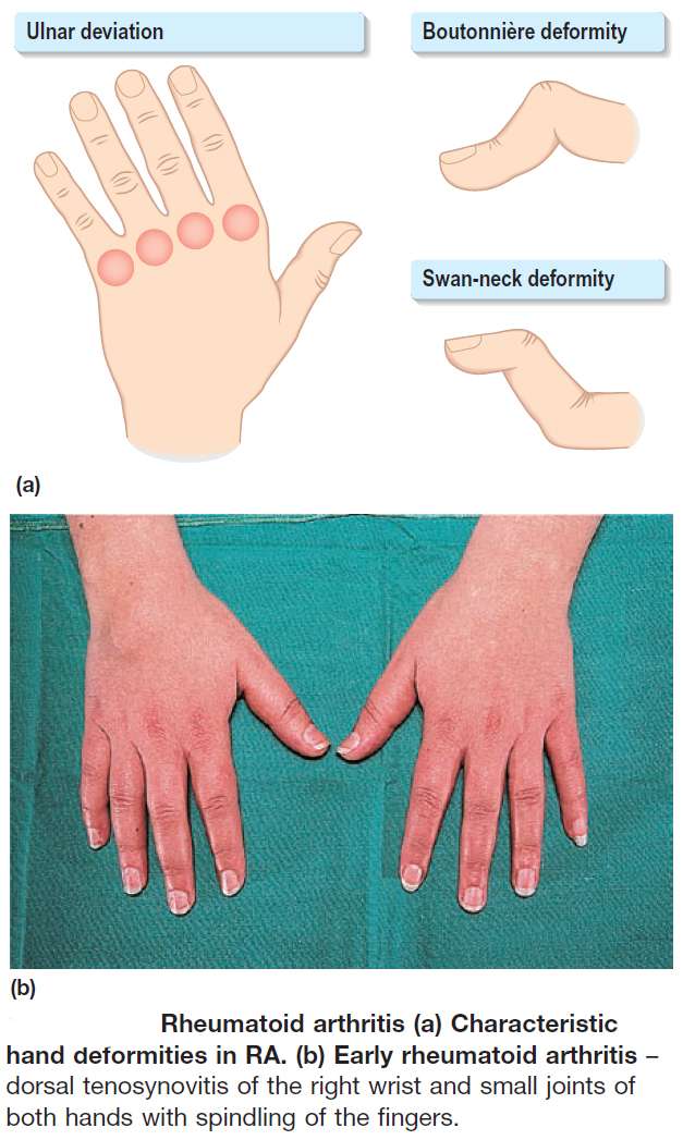 Rheumatoid Arthritis Characteristic Hand Deformities