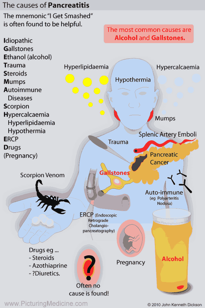 The Causes of Acute Pancreatitis