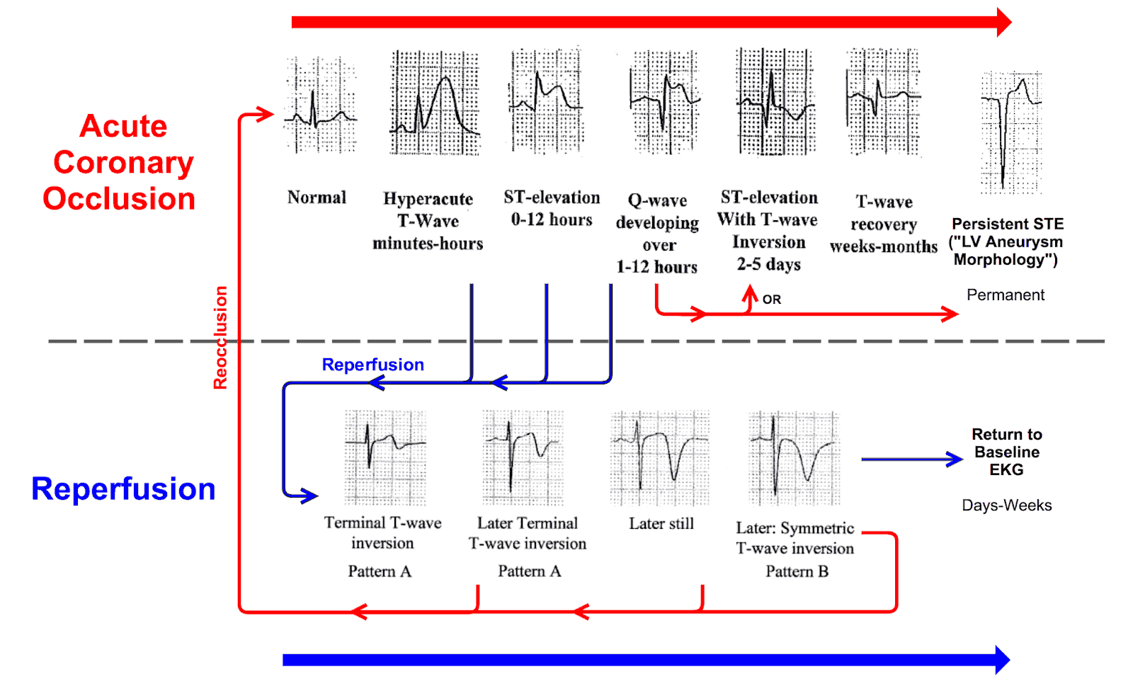 The progression of ECG findings seen during acute coronary occlusion and reperfusion