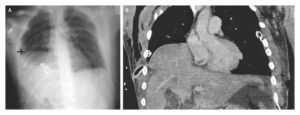 Read more about the article Traumatic Diaphragmatic Rupture with Intrathoracic Liver Herniation