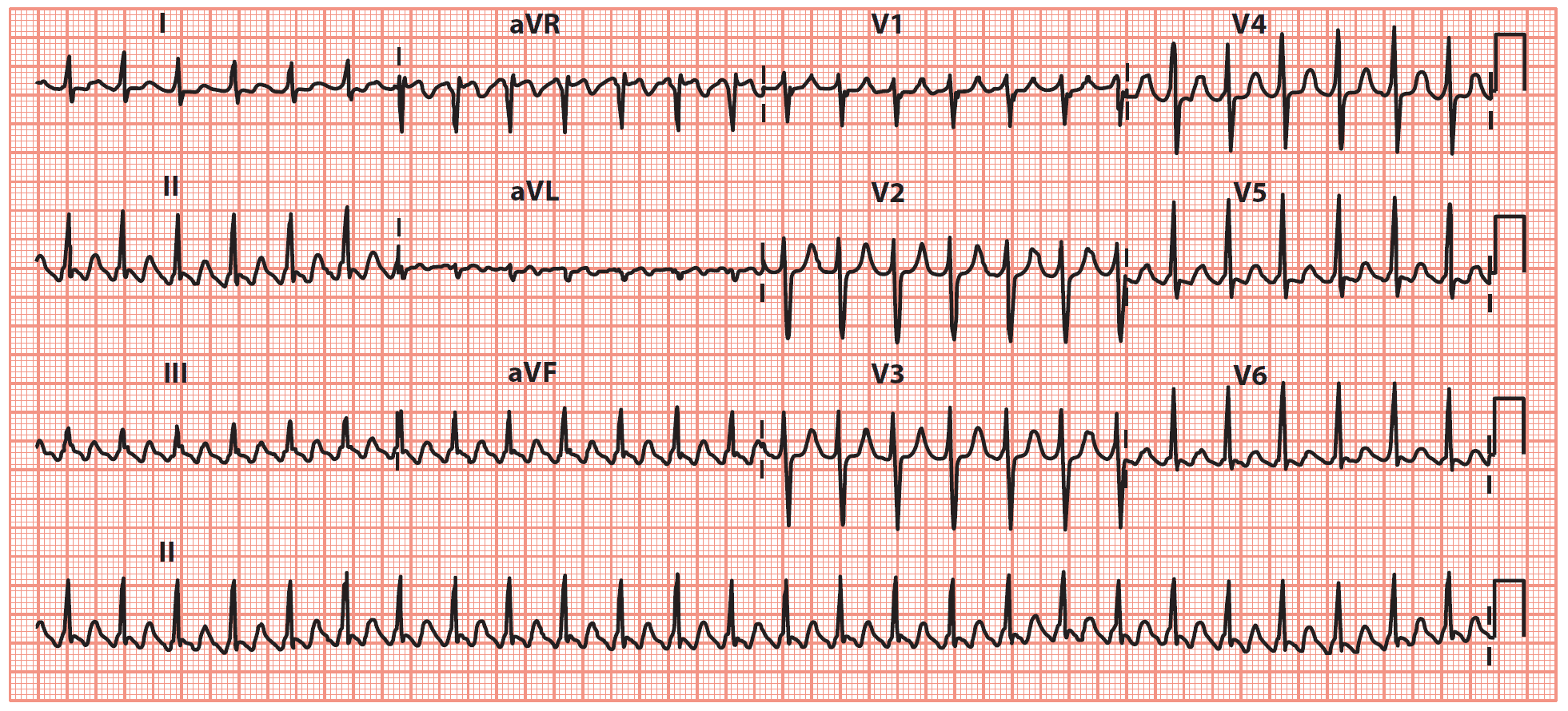 Atrial Flutter with ‘sawtooth’ pattern of atrial activity, with an atrial rate of 300/min and a ventricular rate of 150/min (indicating 2:1 AV block)