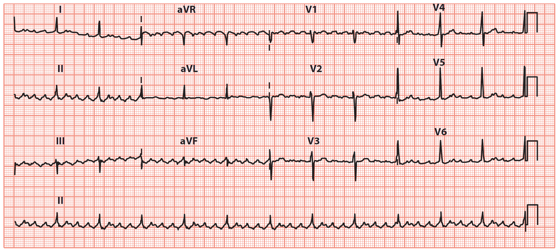 Atrial Flutter with ‘sawtooth’ pattern of atrial activity, with an atrial rate of 288/min and a ventricular rate of 72/min (indicating 4:1 AV block)