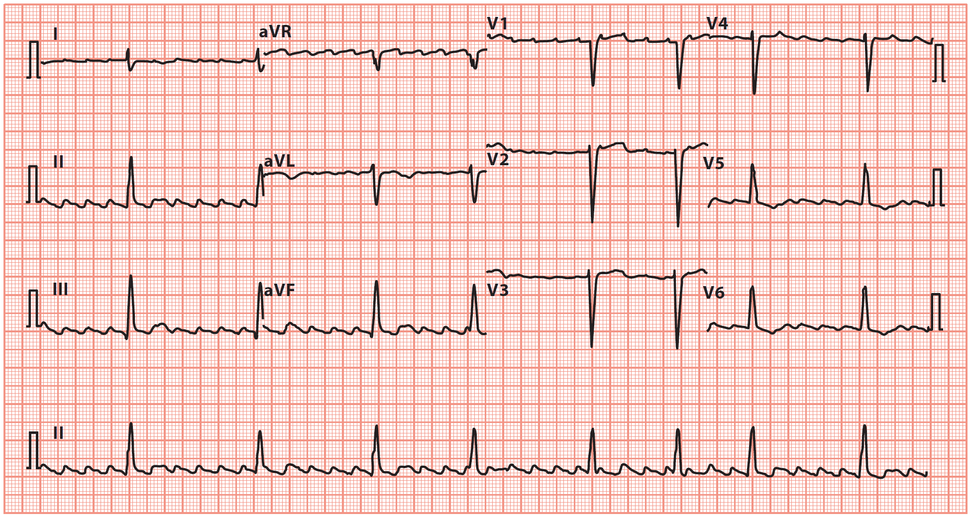 Atrial Flutter with ‘sawtooth’ pattern of atrial activity, with an atrial rate of 250/min and a ventricular rate of 48/min. The ventricular rhythm is irregular, indicating variable AV block.