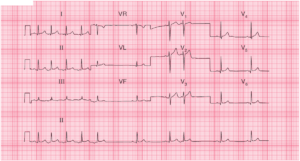 Read more about the article Sinus Rhythm with Atrial Tachycardia
