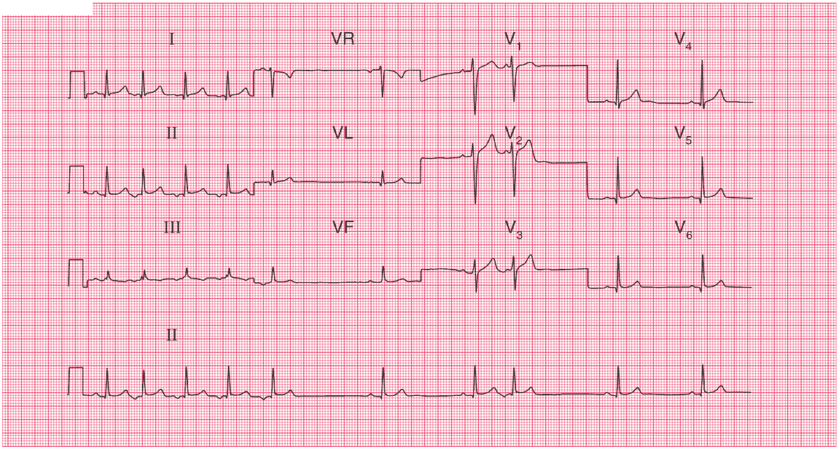 Read more about the article ECG Case 50
