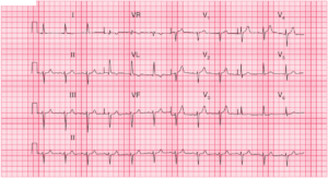 Read more about the article ECG Case 51: Left Anterior Fascicular Block (LAFB) and Left Ventricular Hypertrophy