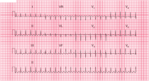 Read more about the article ECG Case 52: Atrial Flutter with 2:1 Block