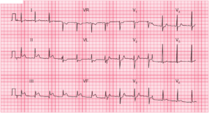 Read more about the article ECG Case 53: Acute Inferior and Posterior Myocardial Infarction