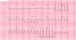 Read more about the article ECG Case 54: Wolff-Parkinson-White (WPW) Syndrome type A
