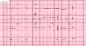 Read more about the article ECG Case 55: Sinus Rhythm with First Degree AV Block