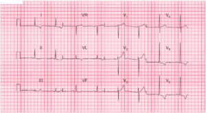 Read more about the article ECG Case 56