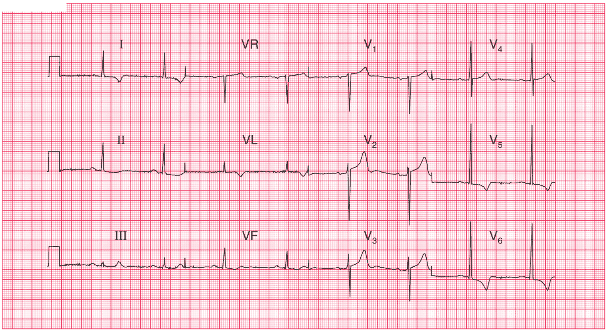 ECG of Left Ventricular Hypertrophy (LVH) from Aortic Stenosis with strain pattern